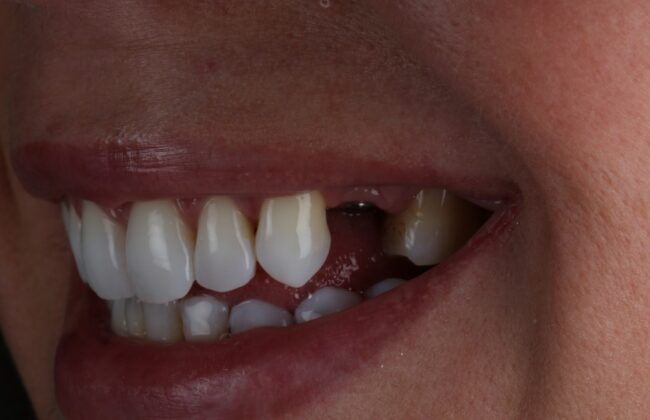 Before (Teeth)