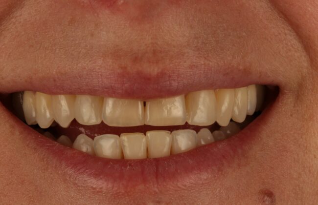 After (Teeth)