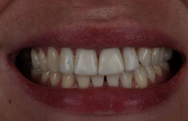 After (Teeth)