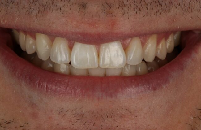 After (Teeth)