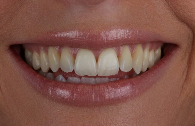 After (Teeth)