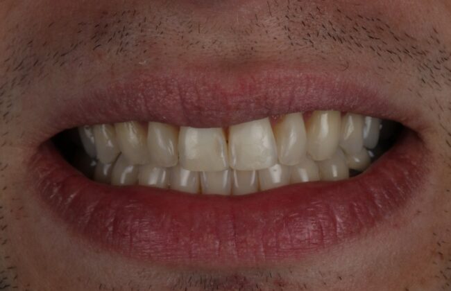 After (Teeth)
