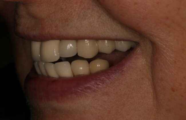 Before (Teeth)