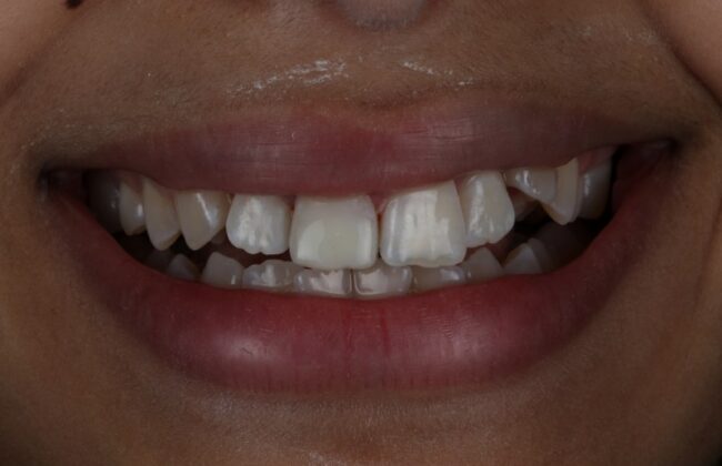 After (Teeth)