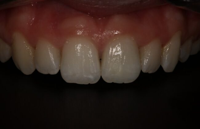 After (Teeth)