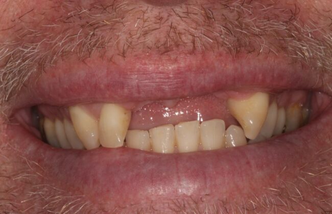 Before (Teeth)