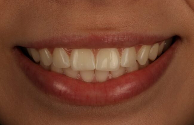 After (Teeth)