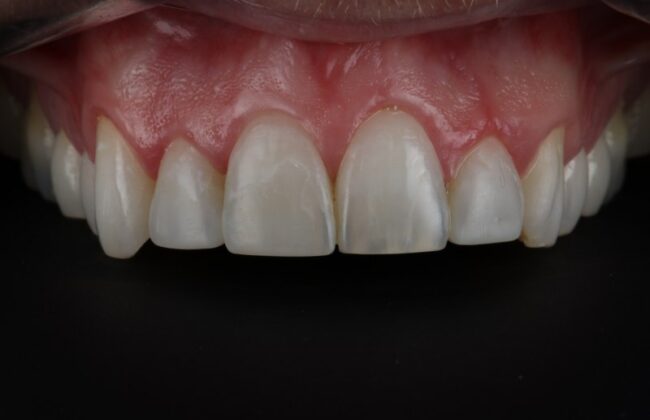 After (Teeth)