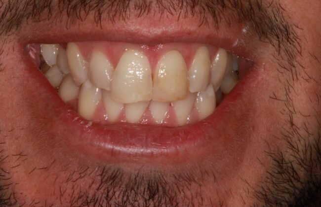 Before (Teeth)