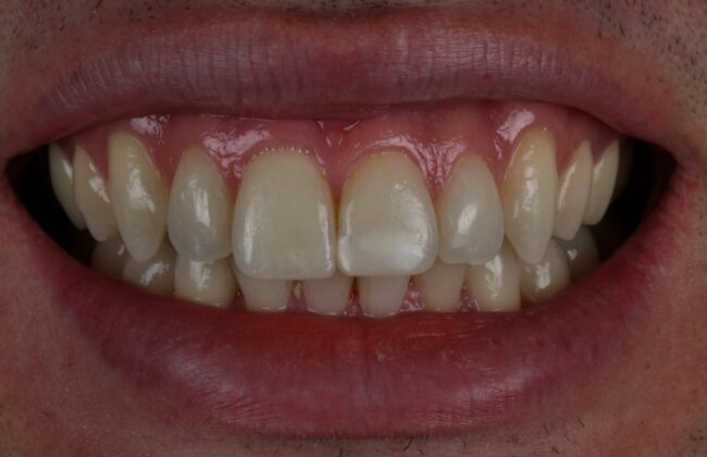 After (Teeth)