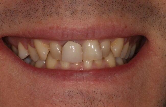 Before (Teeth)