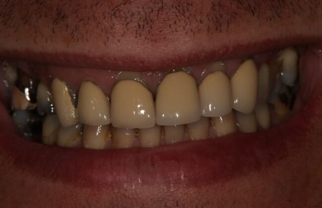 Before (Teeth)