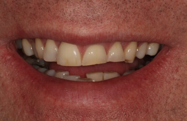 Before (Teeth)