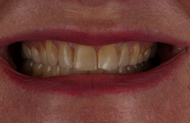 After (Teeth)