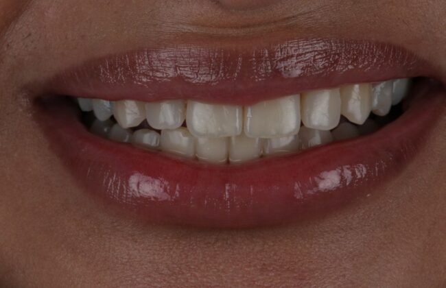 After (Teeth)