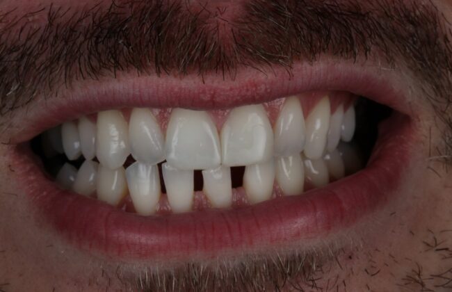 After (Teeth)