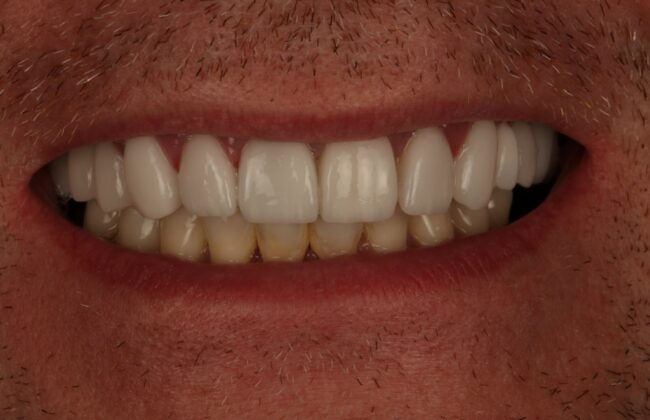 After (Teeth)