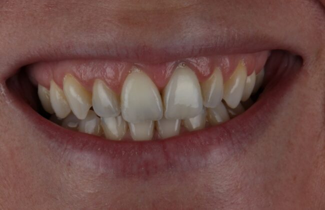 After (Teeth)