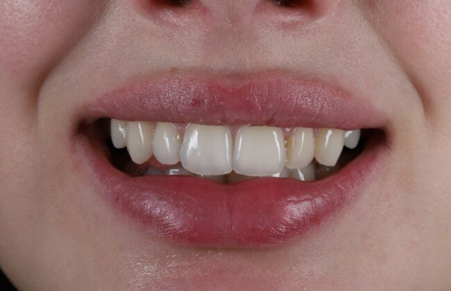 After (Teeth)