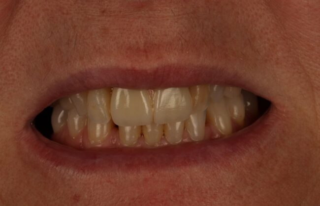 After (Teeth)