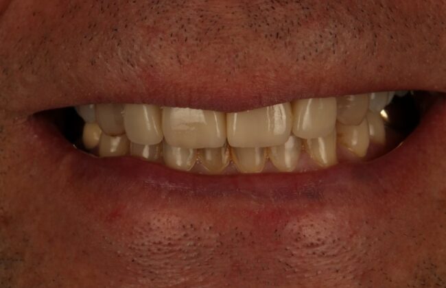 After (Teeth)