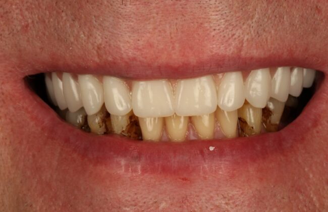 After (Teeth)