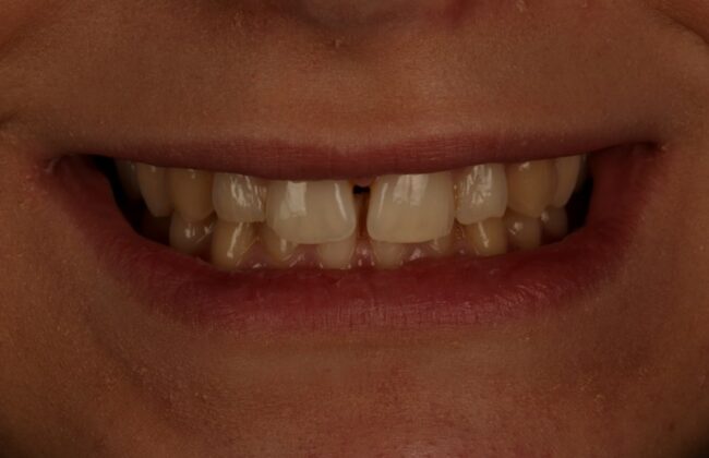 Before (Teeth)