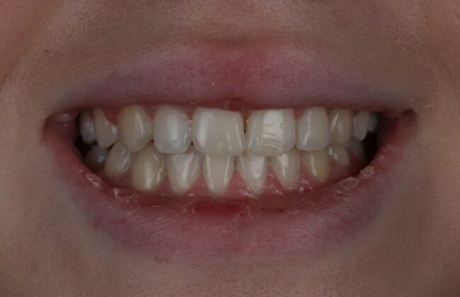 After (Teeth)