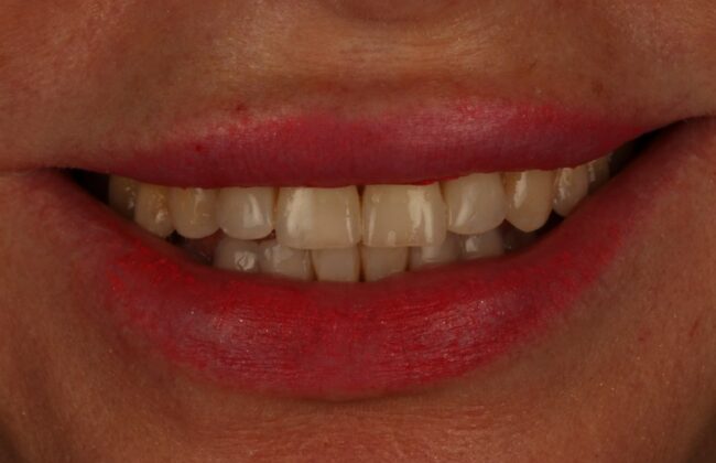 After (Teeth)