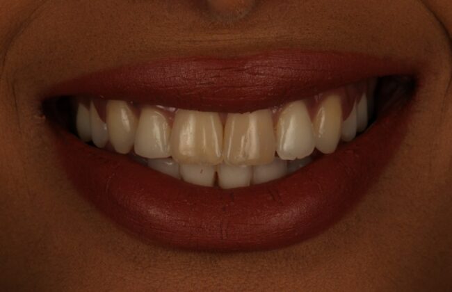 After (Teeth)