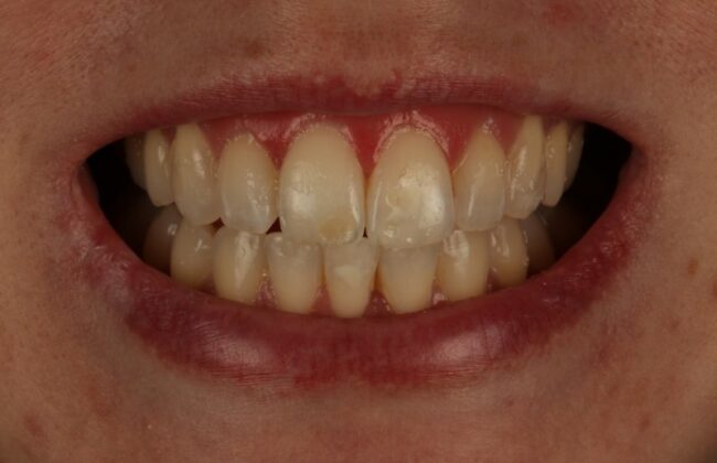After (Teeth)