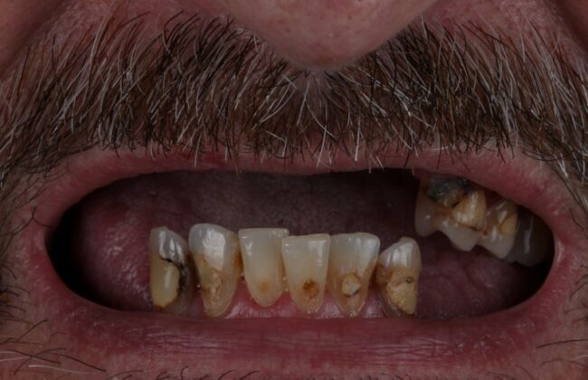 Before (Teeth)