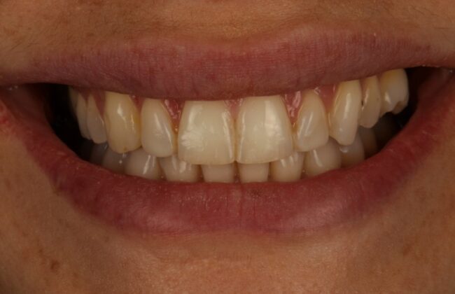 After (Teeth)