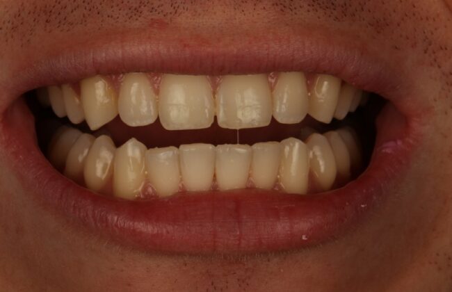 After (Teeth)