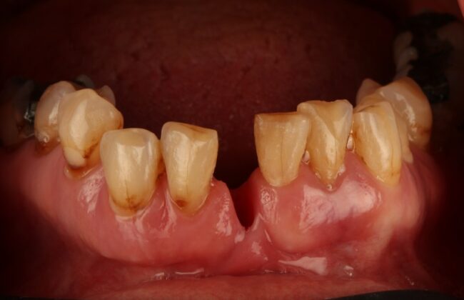 Before (Teeth)