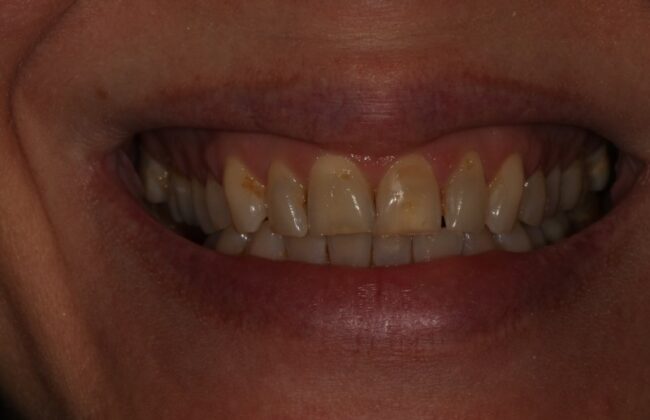 Before (Teeth)