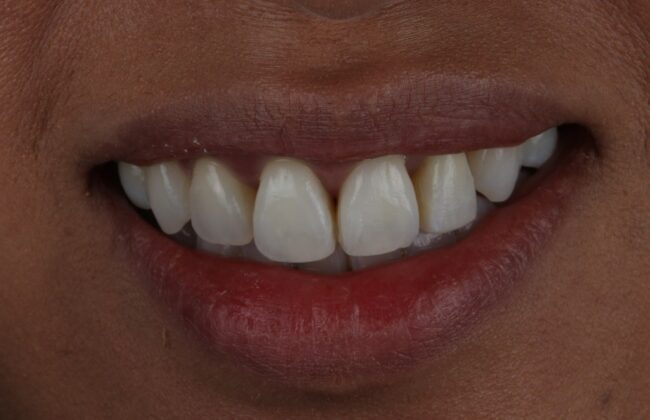 After (Teeth)