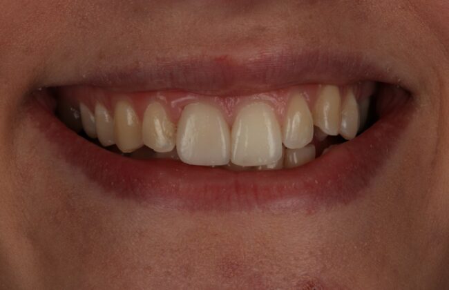 After (Teeth)