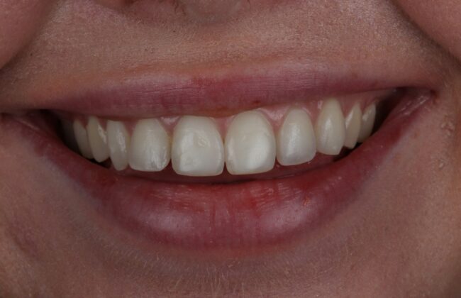 After (Teeth)