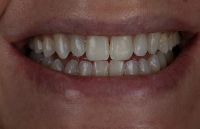 After (Teeth)