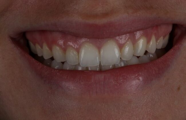 After (Teeth)