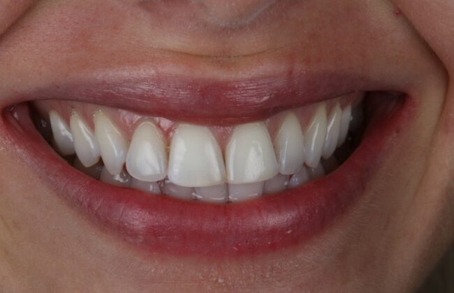 After (Teeth)