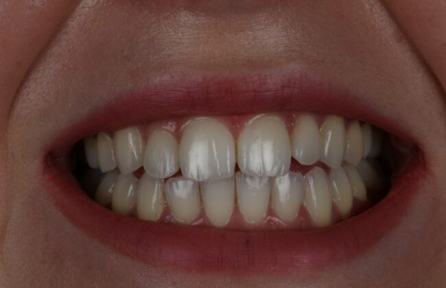 After (Teeth)