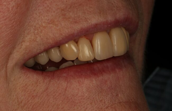 After (Teeth)