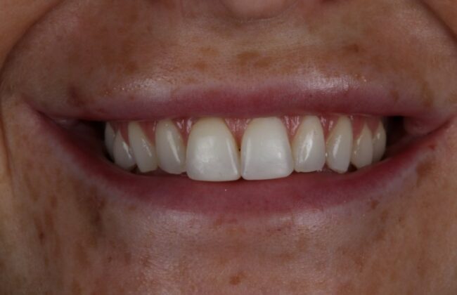 After (Teeth)