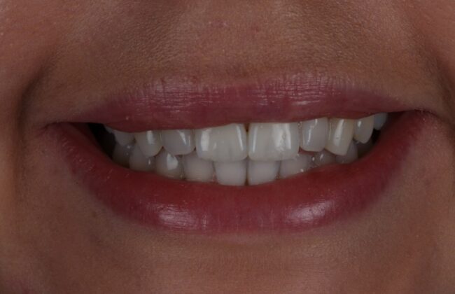 After (Teeth)