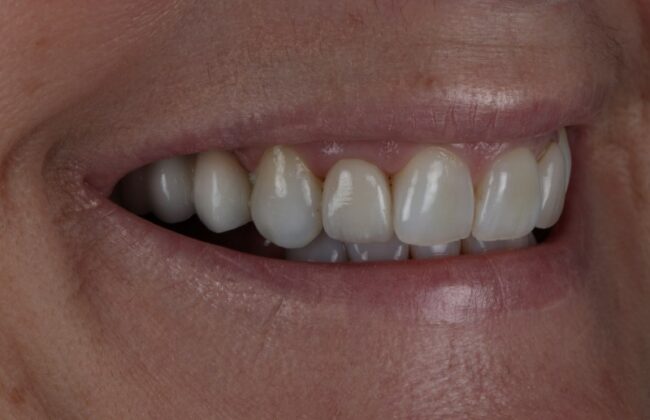 After (Teeth)
