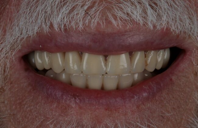 After (Teeth)