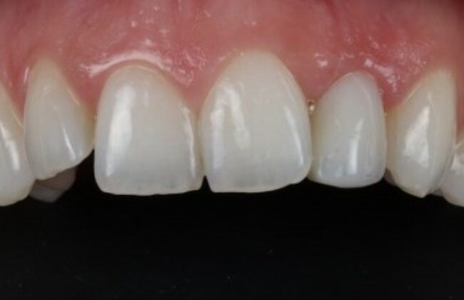 After (Teeth)
