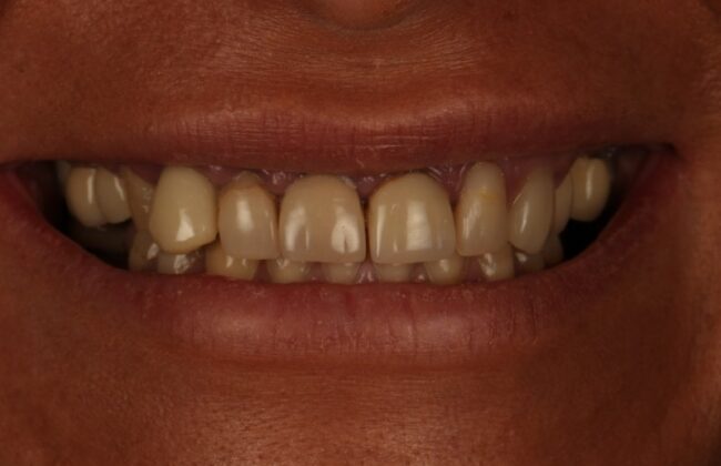 Before (Teeth)